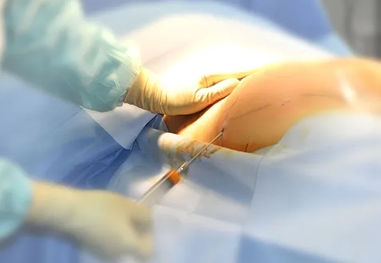 La Procedure du Lipofilling Fessier img 5