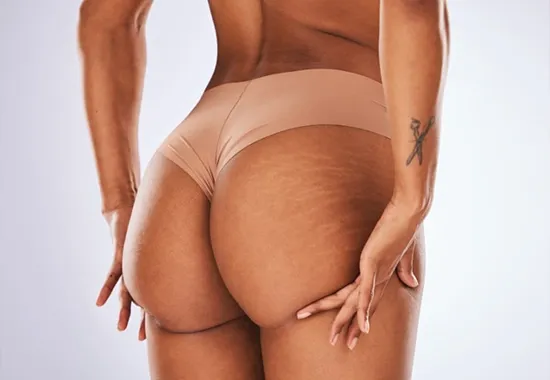 La Procedure du Lipofilling Fessier img 6
