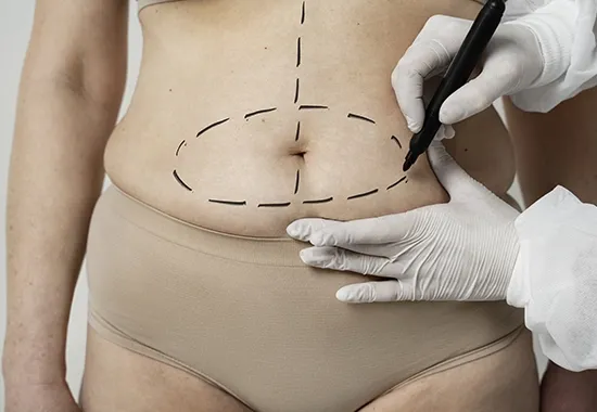 abdominoplastie tunisie img 2