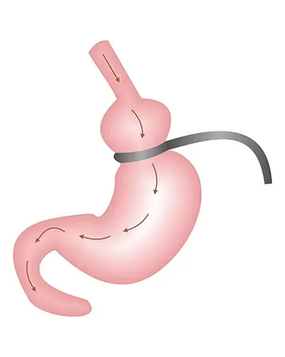 anneau gastrique 3200 euros
