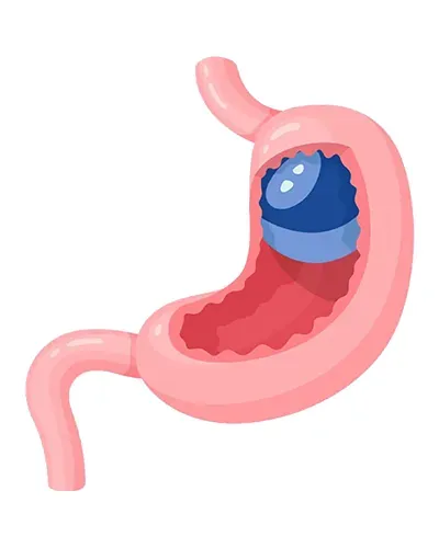 ballon gastrique 1 an 2800 euros