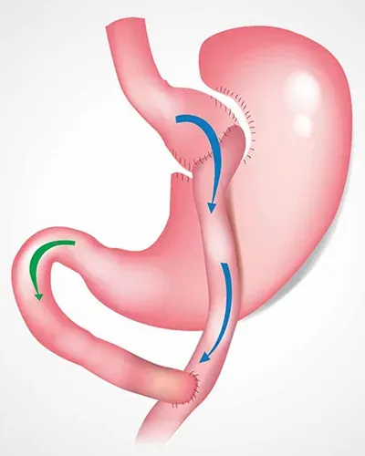 bypass gastrique 4150 euros