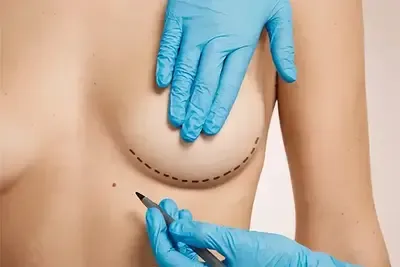 chirurgie mammaire
