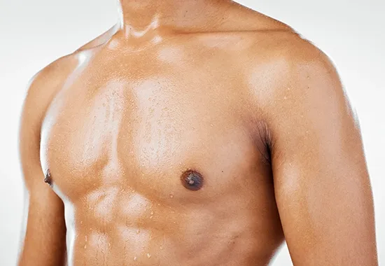 gynecomastie en tunisie img 2