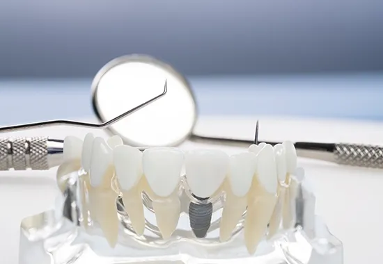 implant dentaire en tunisie img 2