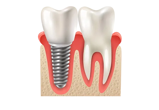 implants dentaire tunisie img 1