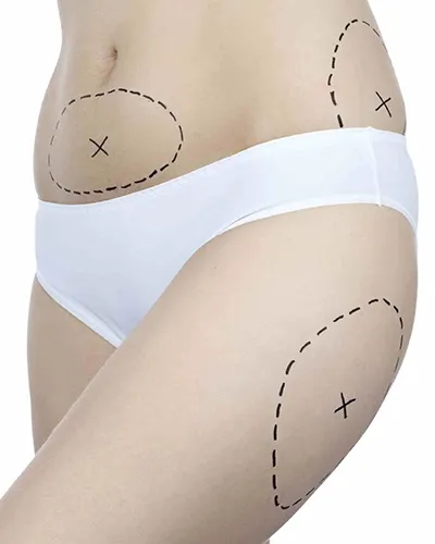 liposuccion moyenne