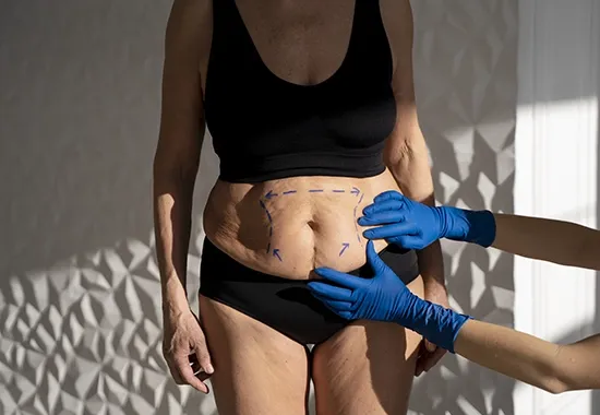 quest ce que abdominoplastie img 3