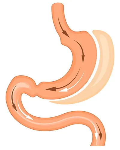 sleeve gastrique 3950 euros